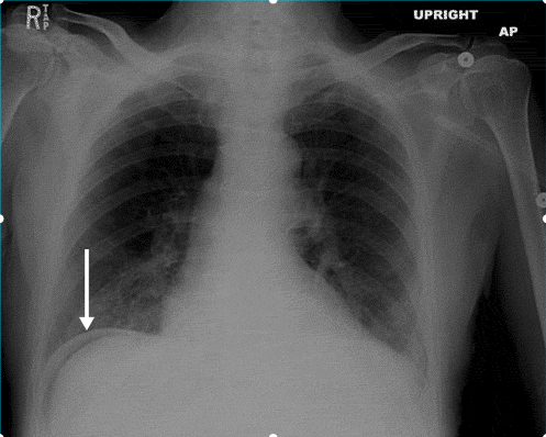 Upright CXR showing pneumoperitoneum