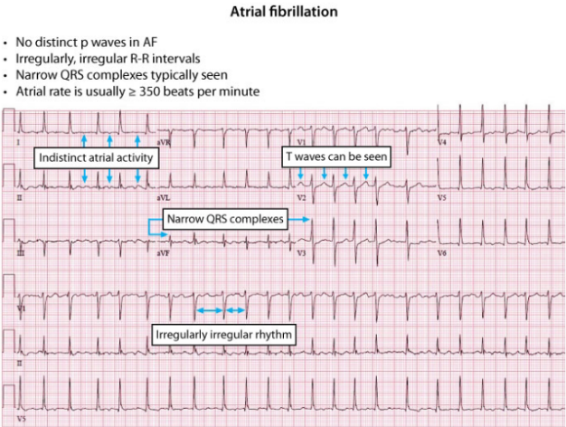 ECG showing atrial fibrillation with absent P waves and irregular RR intervals