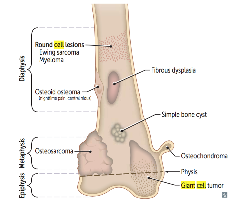 Anatomical localization of bone tumors showing GCT in the epiphysis, Osteosarcoma in the metaphysis, and Ewing's in the diaphysis