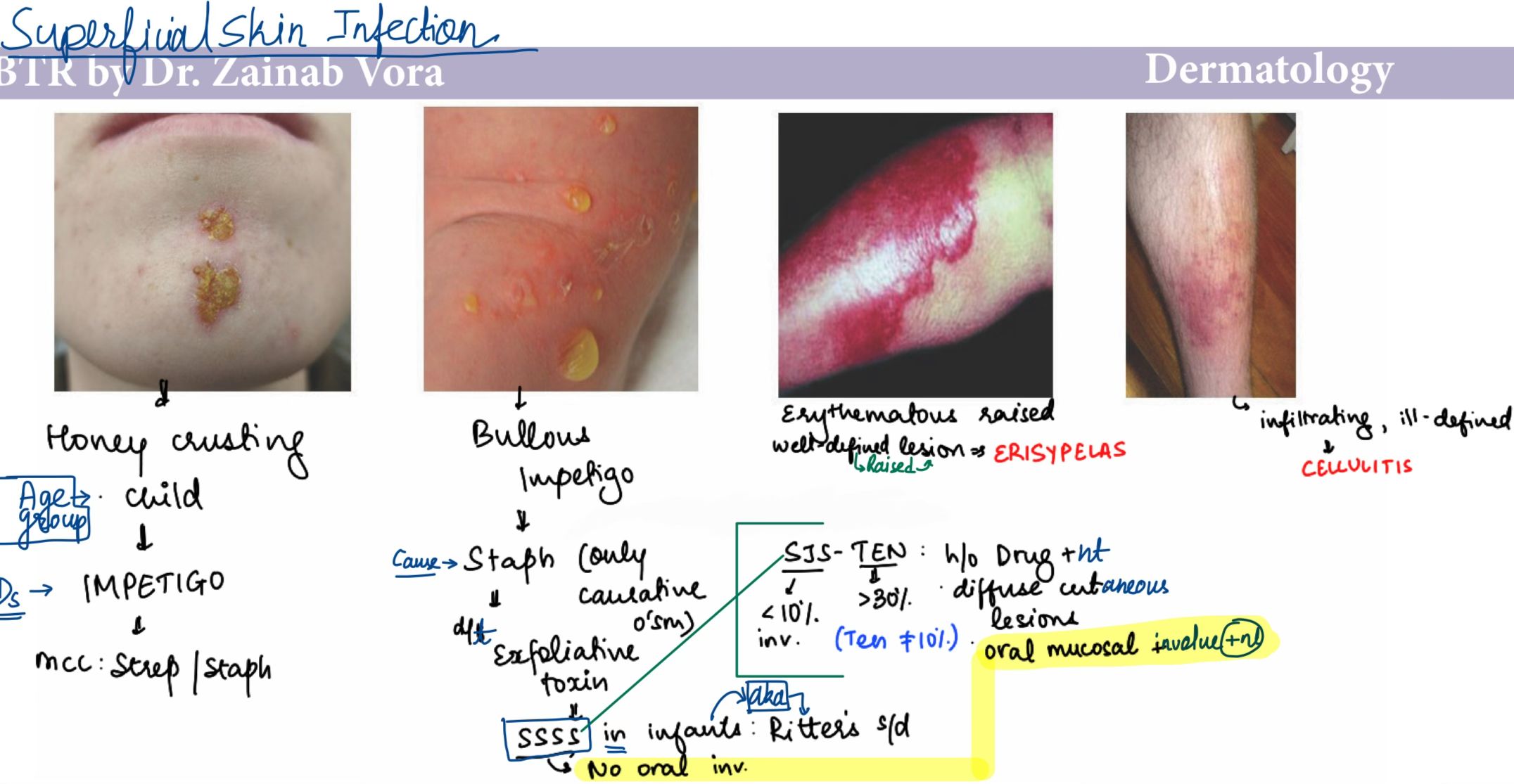 Composite image of bacterial skin infections: non-bullous impetigo, bullous impetigo, erysipelas, and cellulitis