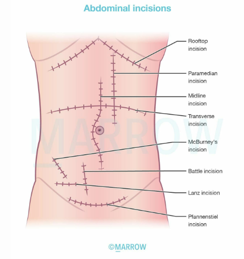 Common Abdominal Incisions