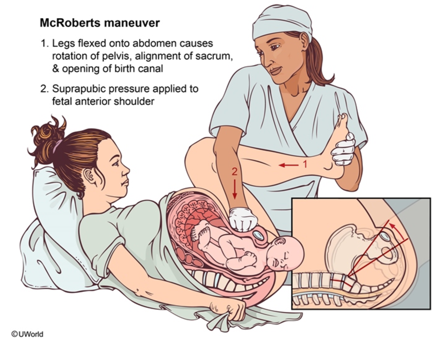 McRoberts Maneuver for Shoulder Dystocia