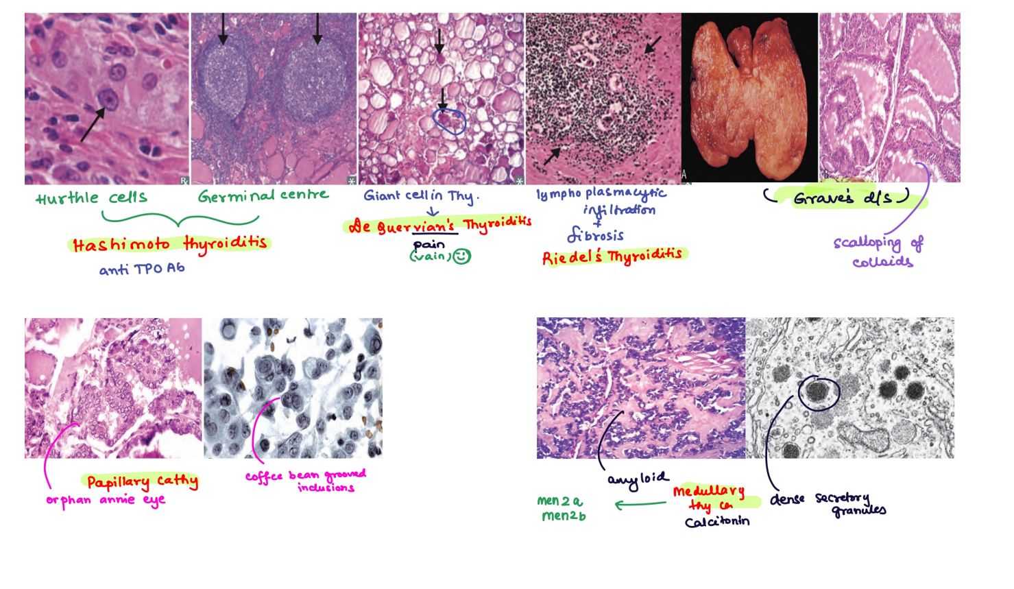 Thyroid Pathologies