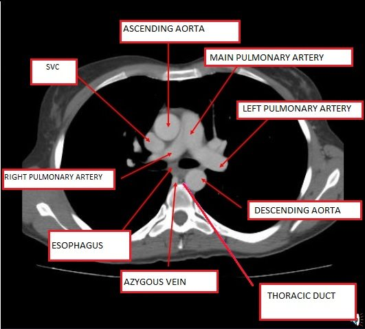 Axial chest CT at T4 level showing ascending/descending aorta, SVC, and trachea bifurcation