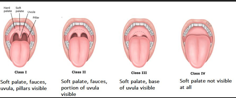 Mallampati Airway Assessment