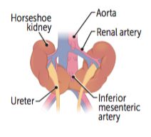Horseshoe kidney diagram showing fusion of lower poles and relationship with the IMA