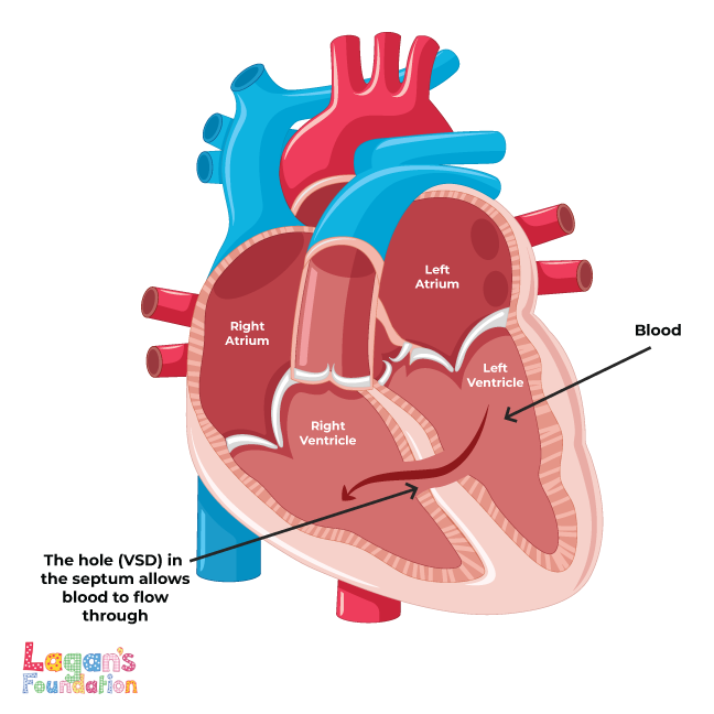 Ventricular Septal Defect (VSD) Diagram