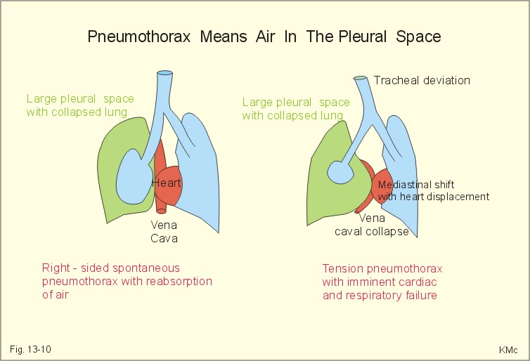 Comparison of Spontaneous and Tension Pneumothorax