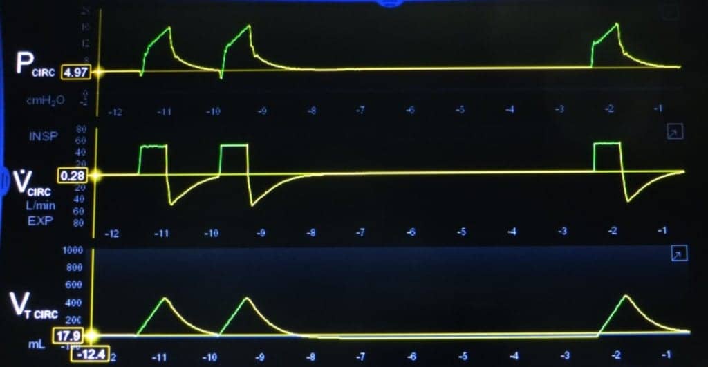 Ventilator Pressure, Flow, and Volume Waveforms