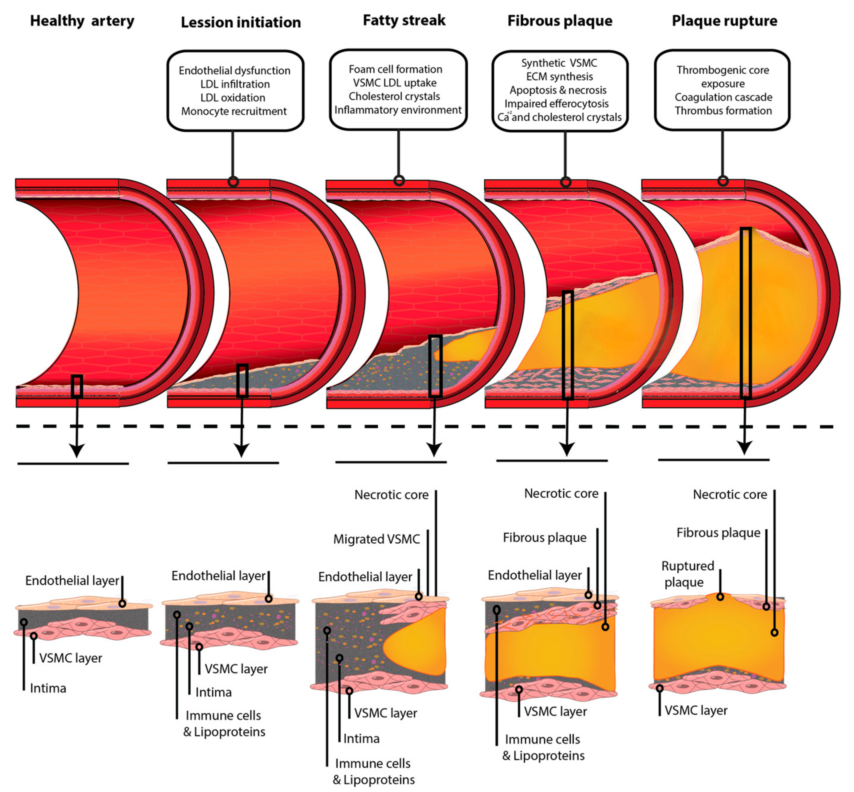 Atherosclerotic plaque development stages