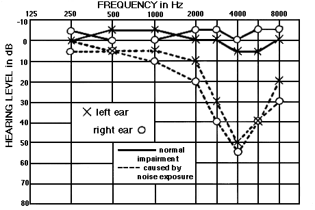 Audiogram: Noise Induced Hearing Loss 4kHz Dip