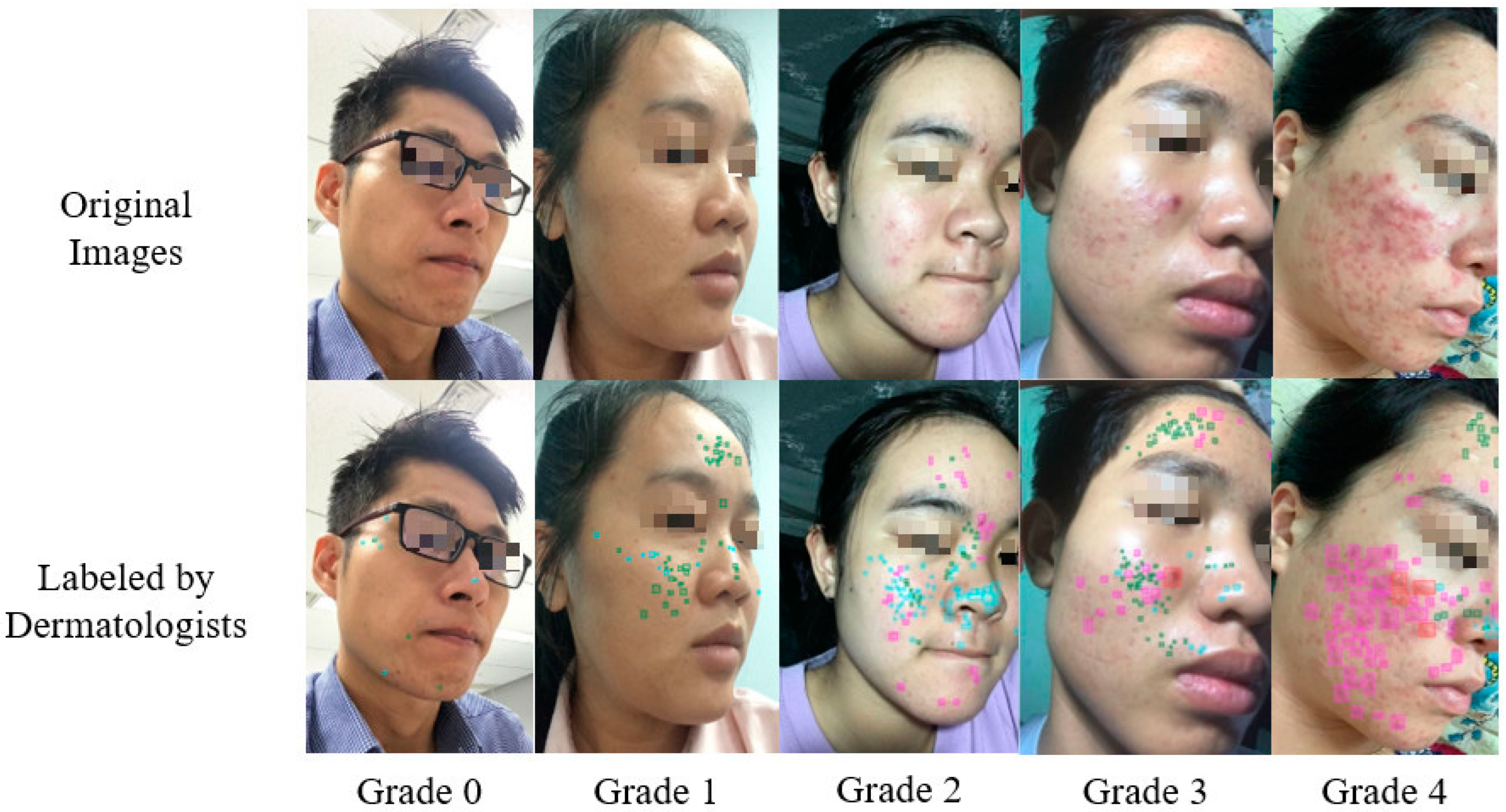 Acne Vulgaris: Management | Acne and Related Disorders - OnCourse NEET-PG