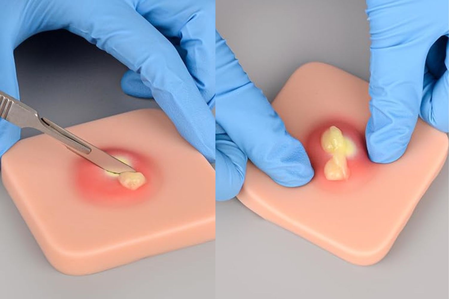 Incision and Drainage of Skin Abscess Model