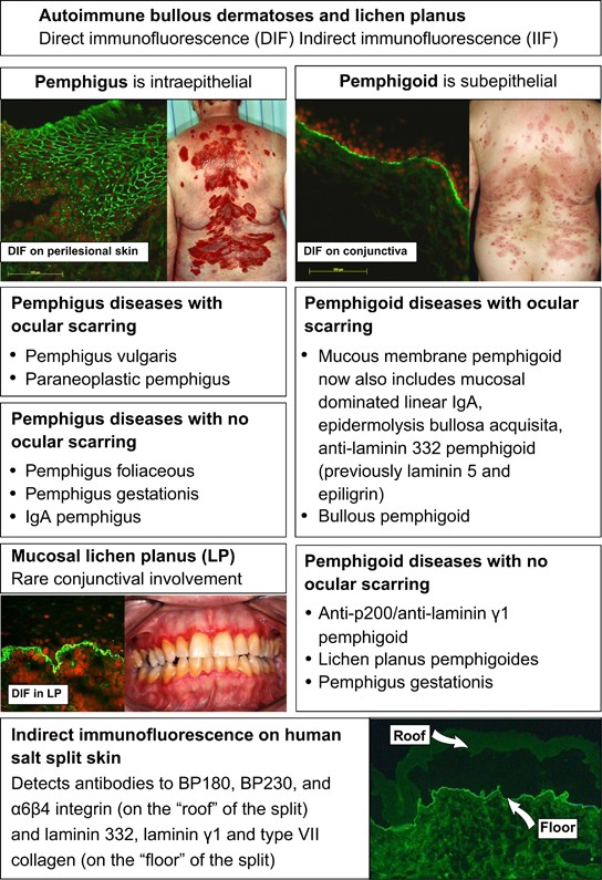 Immunofluorescence patterns in blistering diseases