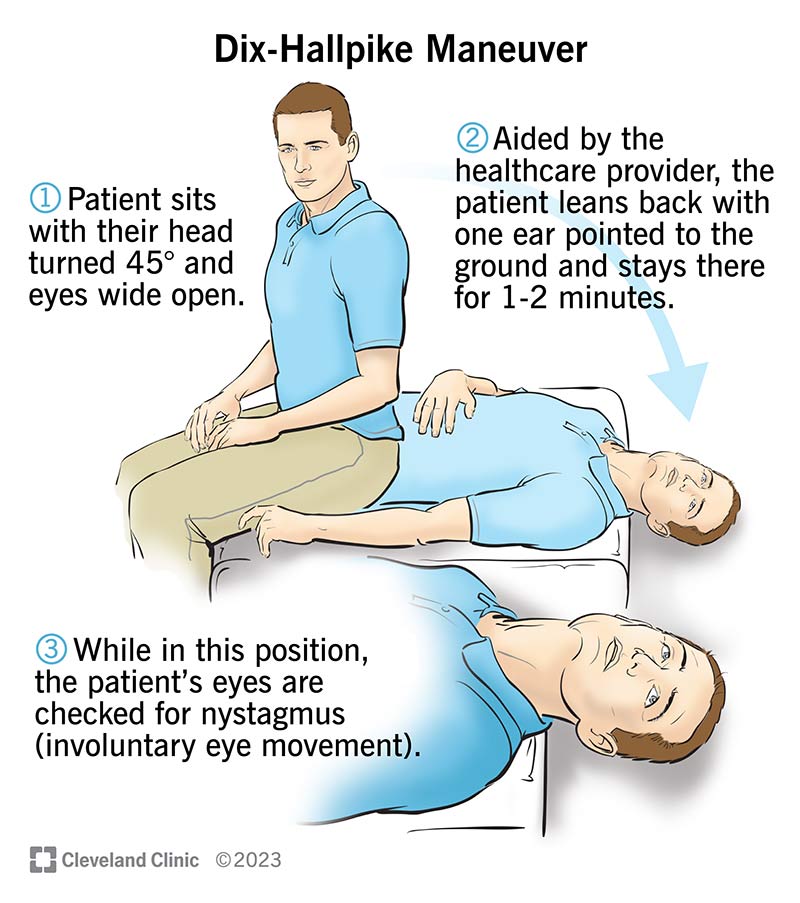 Dix-Hallpike maneuver for BPPV diagnosis