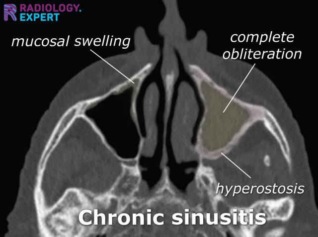 CT scan showing chronic rhinosinusitis