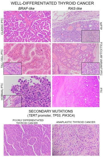 Thyroid Cancer Histopathology Spectrum