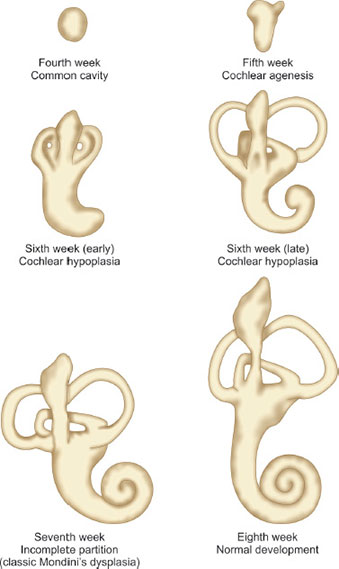 Congenital Anomalies of the Ear | Pediatric Otolaryngology - OnCourse ...