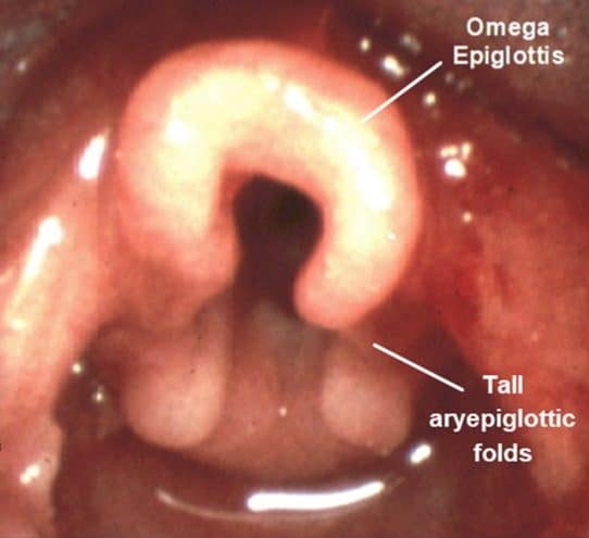 Omega-shaped epiglottis and tall aryepiglottic folds