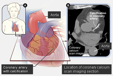 Coronary CTA showing calcification