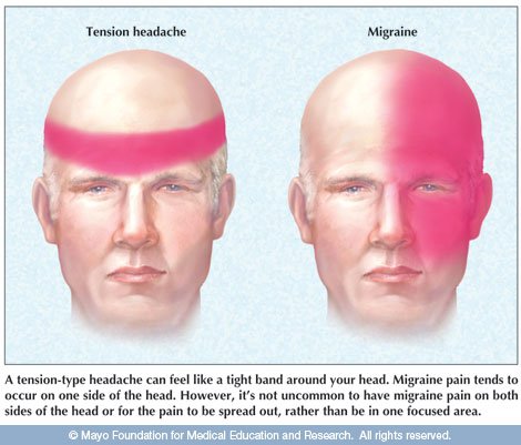 Comparison of tension and migraine headache distribution
