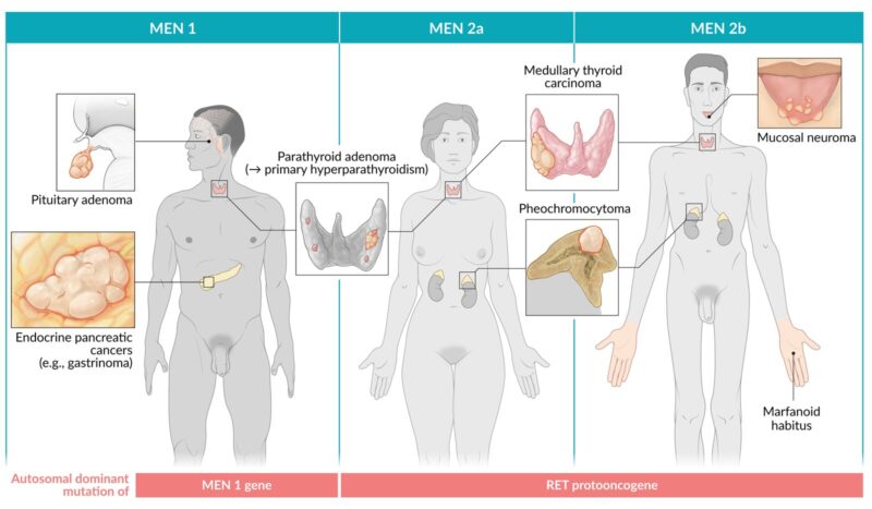 Multiple Endocrine Neoplasia - Free Indian Medical PG Review