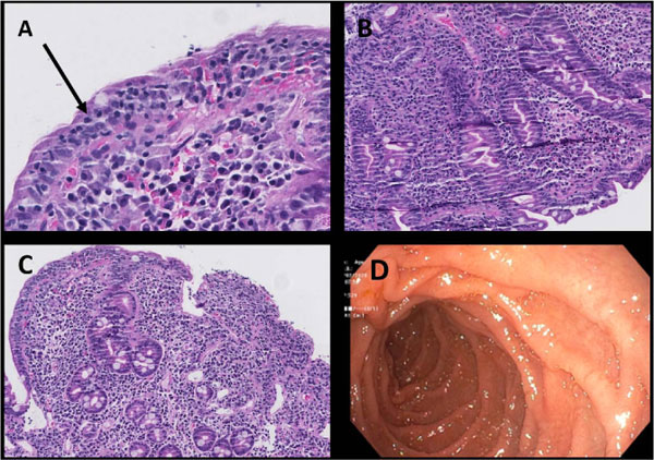 Duodenal biopsy showing villous atrophy and crypt hyperplasia in Celiac disease