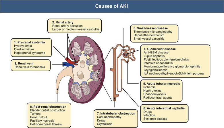 AKI Pathophysiology Diagram