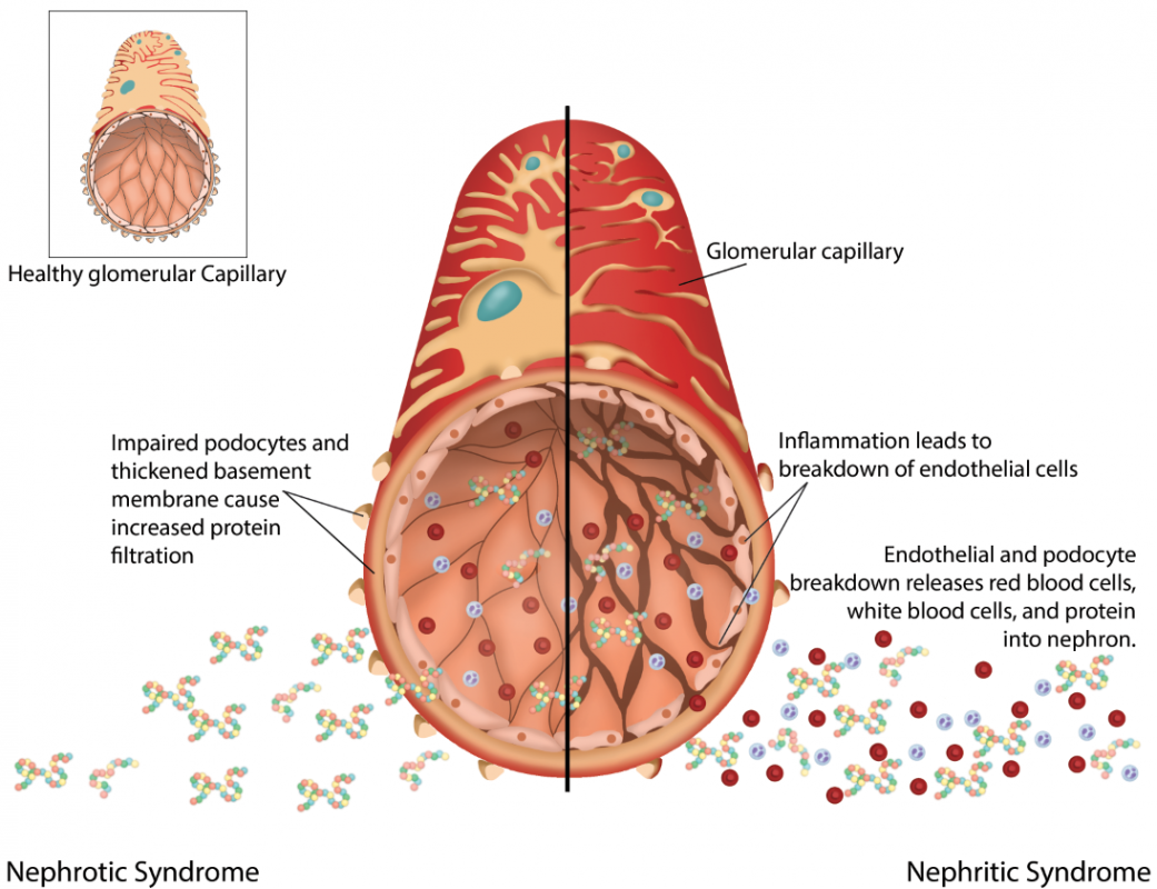 Diagram showing the differences in glomerular damage between Nephrotic and Nephritic syndromes