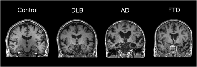 MRI comparison of control, DLB, AD, and FTD