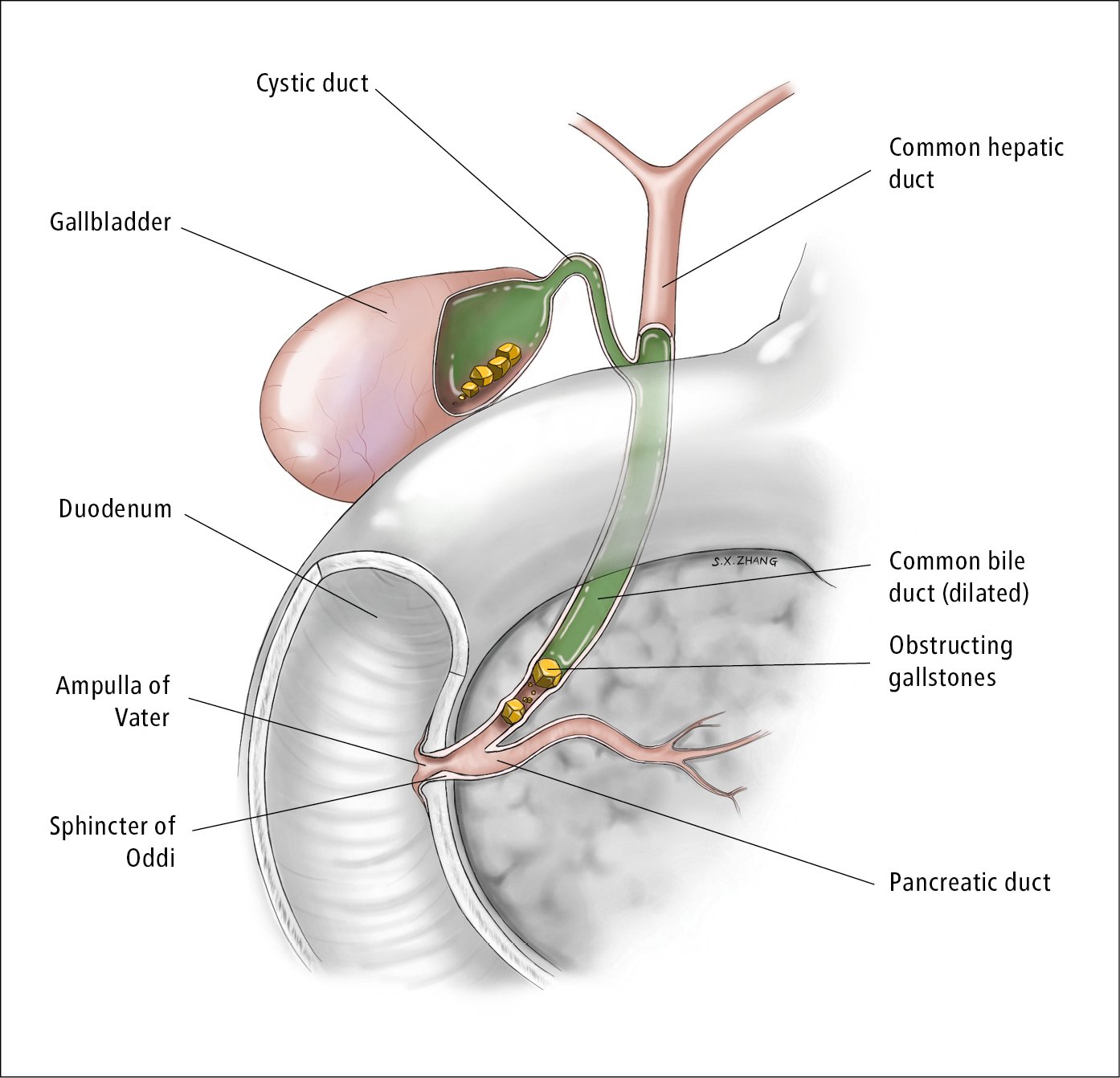 Anatomy of the biliary tree showing gallstones in the gallbladder and common bile duct