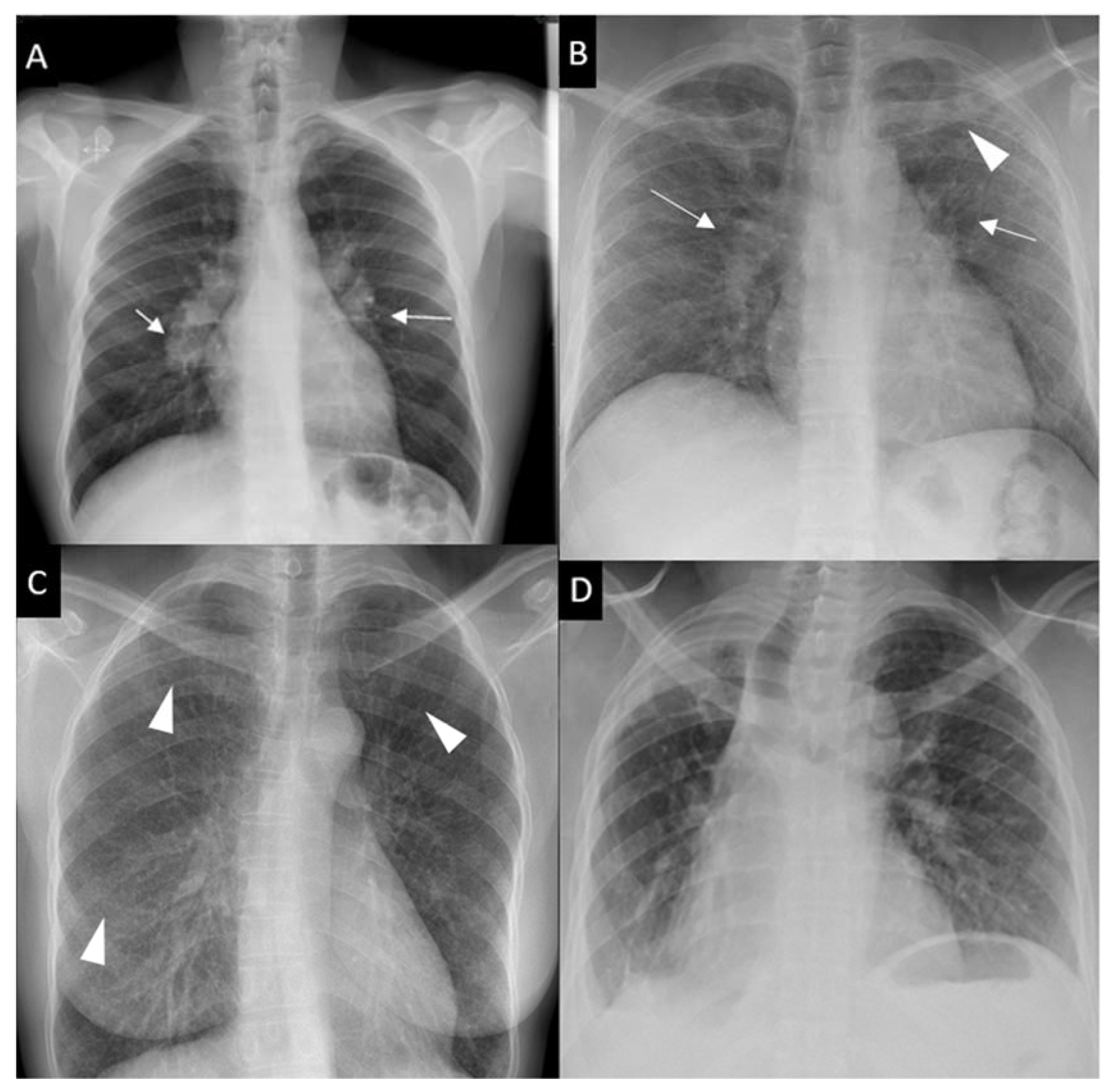 CXR Sarcoidosis Stages I-IV