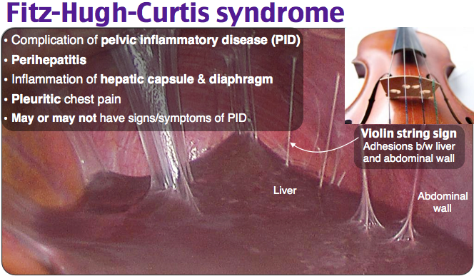 Fitz-Hugh-Curtis syndrome adhesions (violin string)