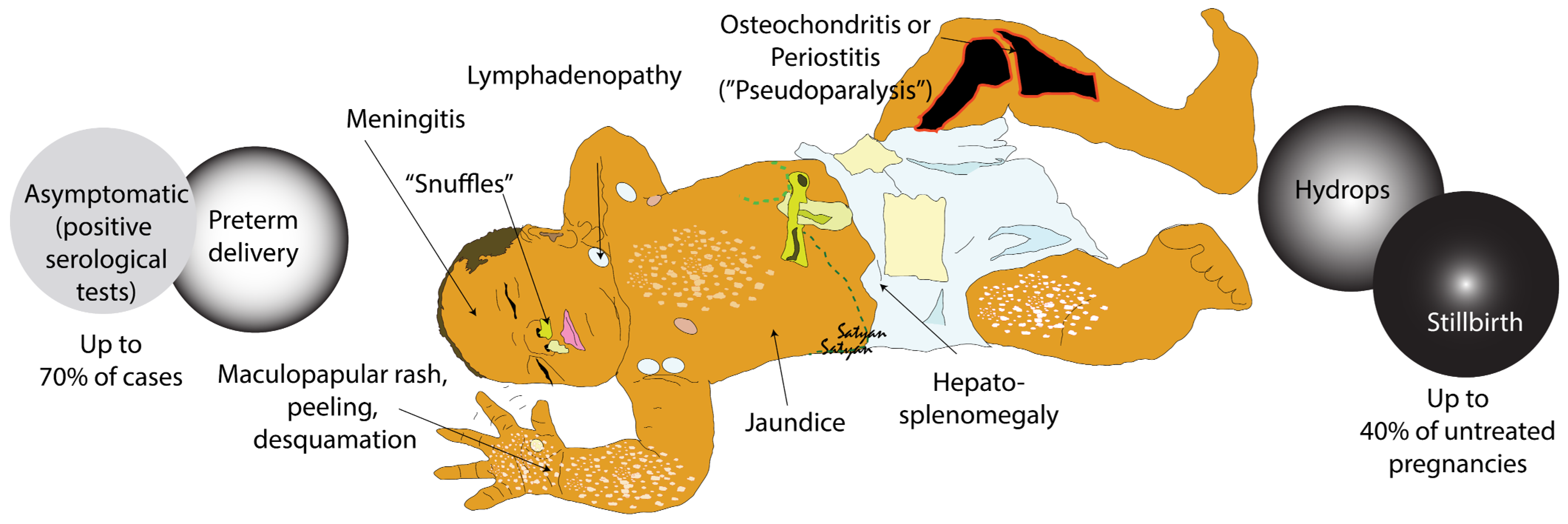Syphilis Diagram Microbiology