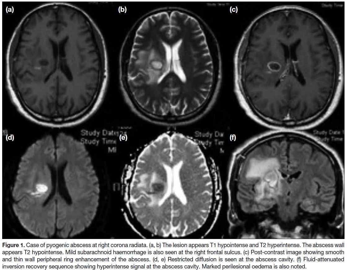 Brain Abscess MRI: Ring Enhancement & Restricted Diffusion