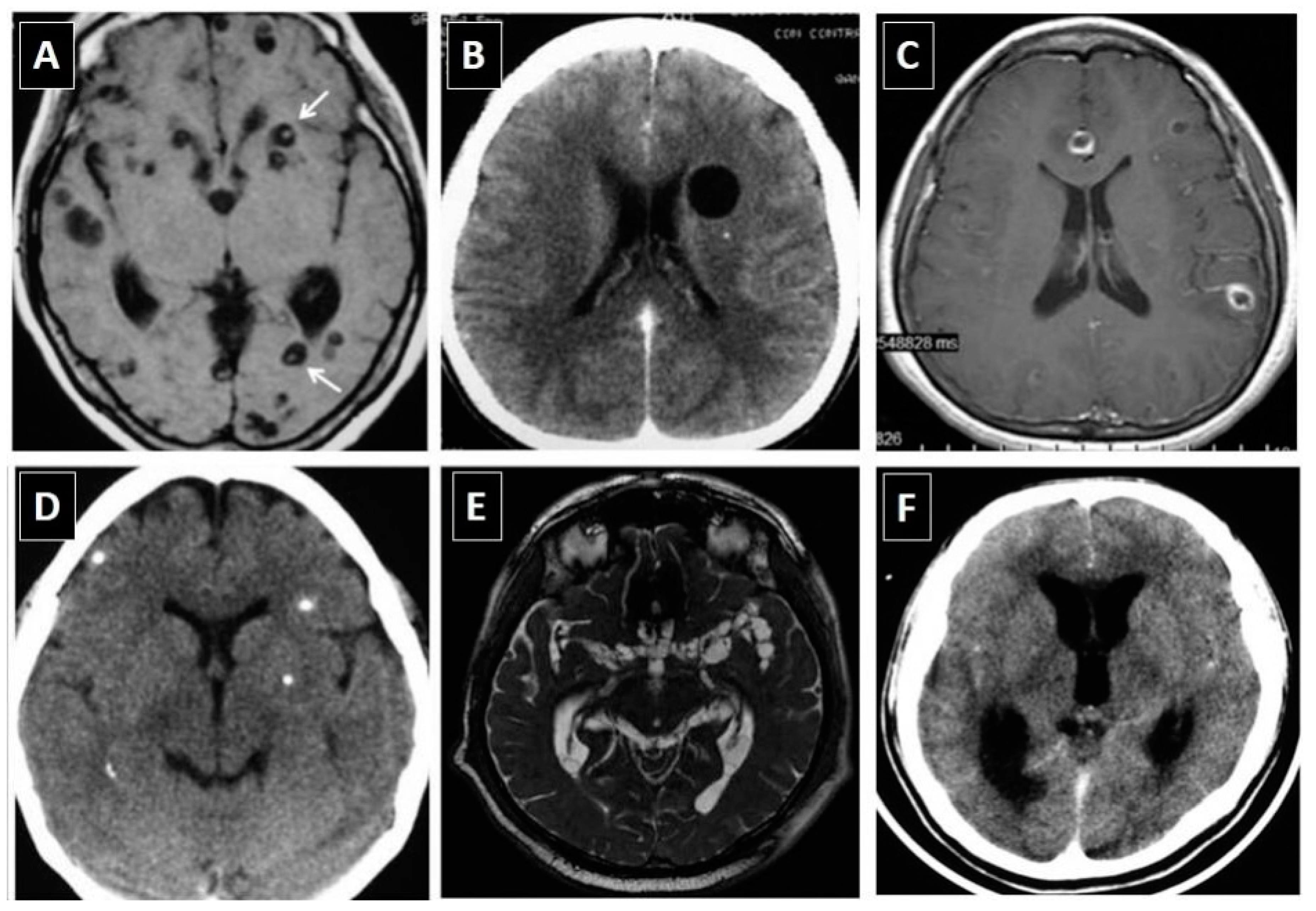 Neurocysticercosis on CT and MRI