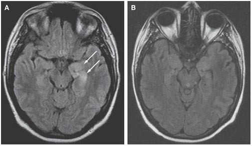 MRI T2 FLAIR HSV encephalitis temporal lobe