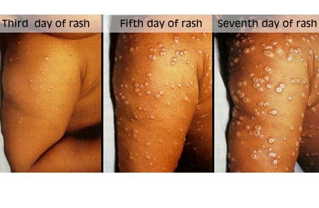 Smallpox rash progression