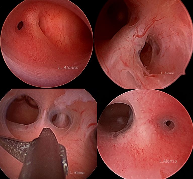 Hysteroscopic view of Asherman's syndrome adhesions