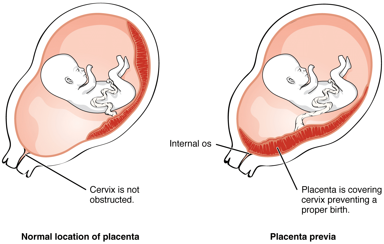 Normal placenta vs. placenta previa