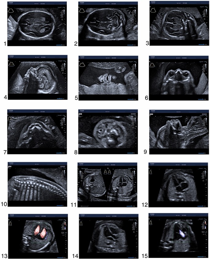 Fetal anomaly scan ultrasound