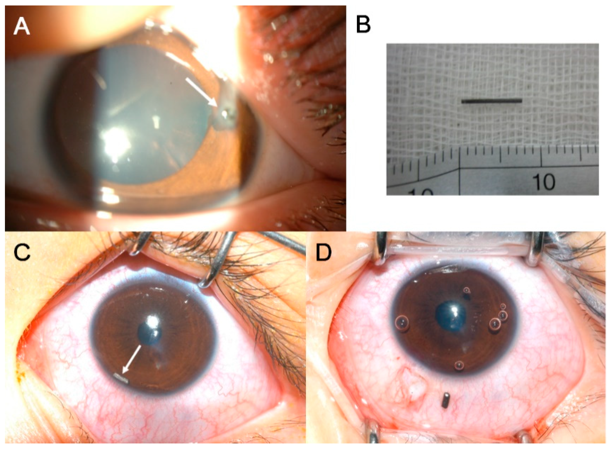 Intraocular foreign body on CT and B-scan