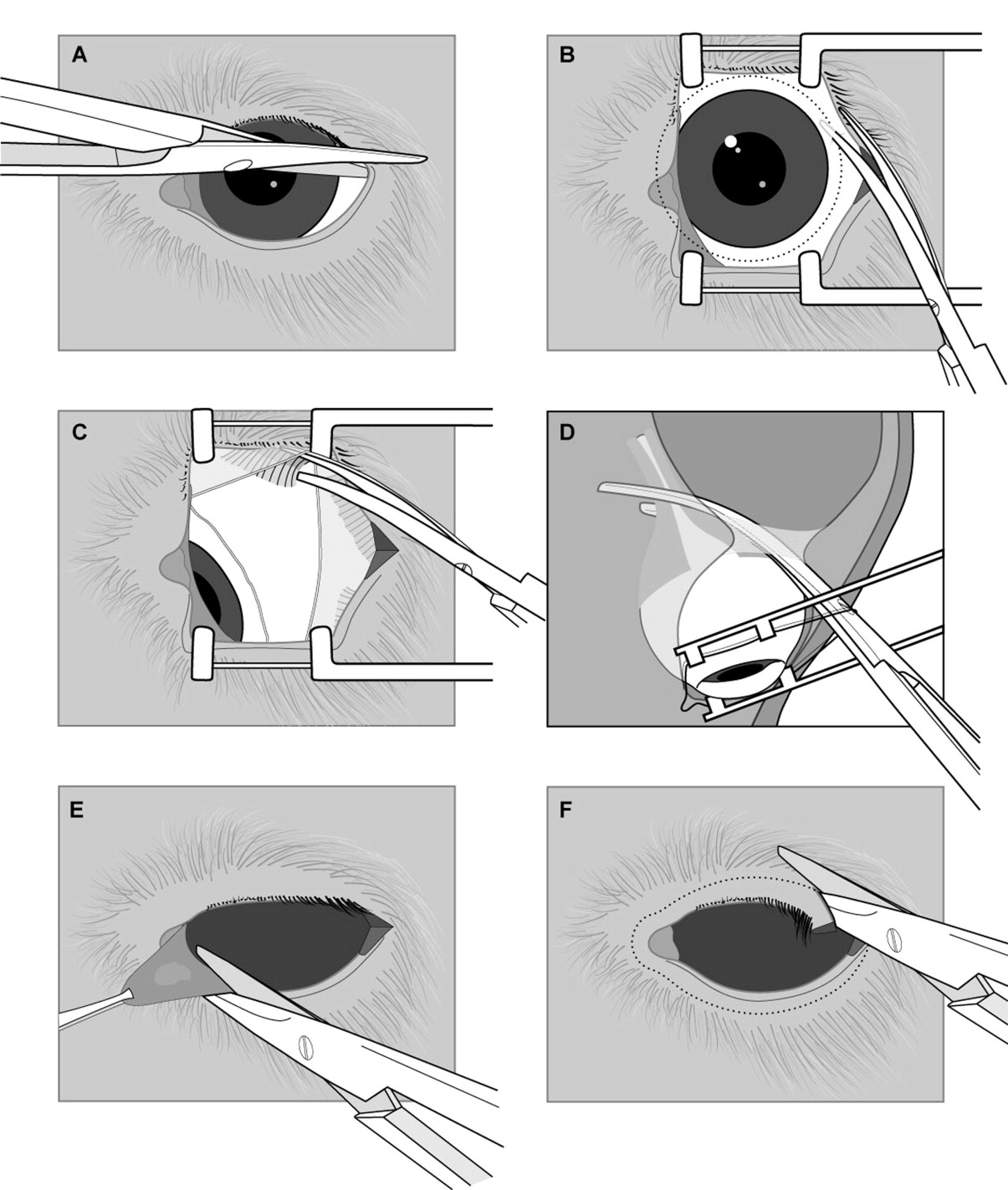 Enucleation and Exenteration | Orbital Diseases - OnCourse NEET-PG