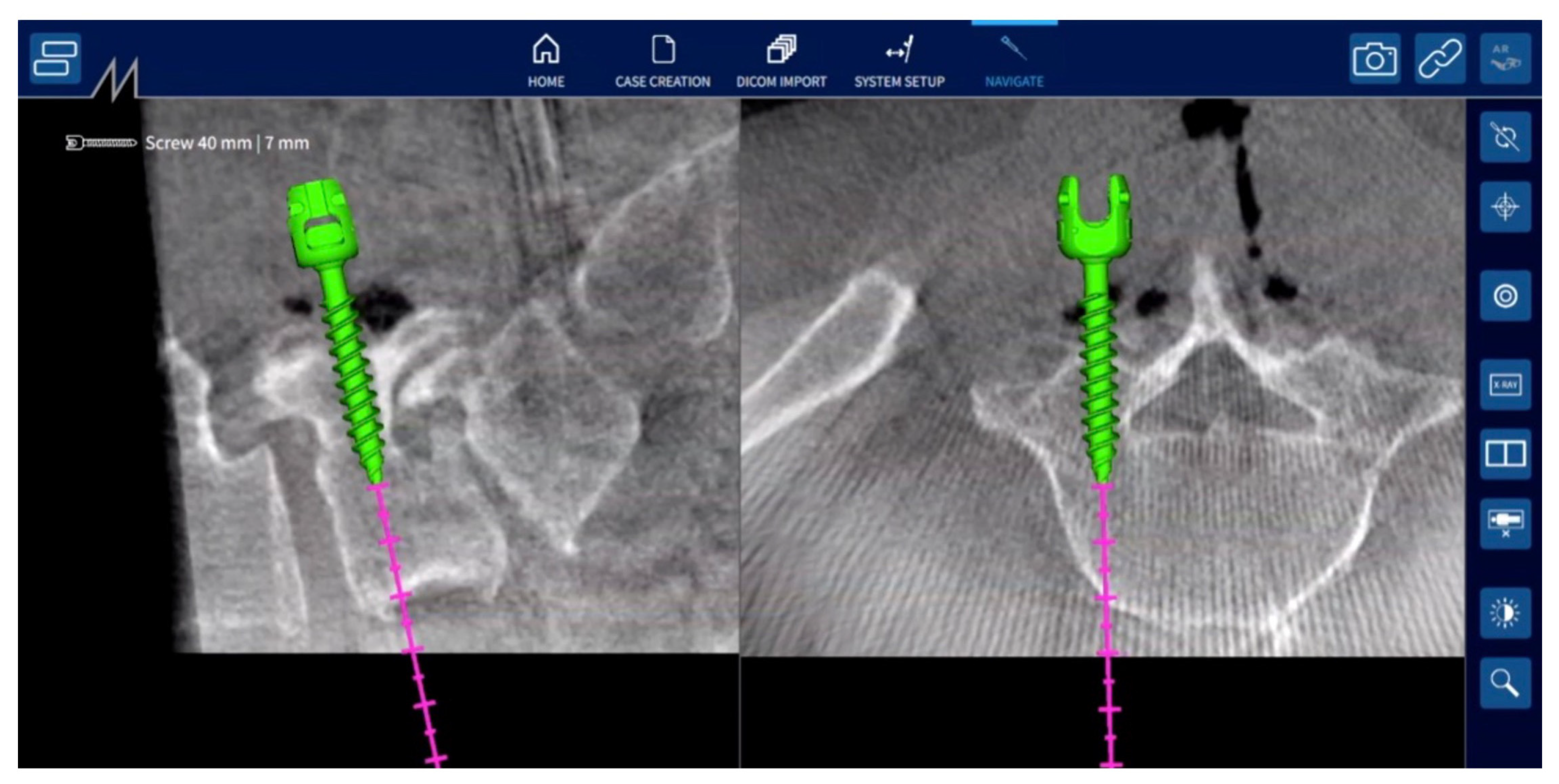Computer-Assisted Spine Surgery | Computer-Assisted Surgery - OnCourse ...