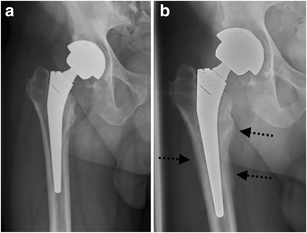 Post-op X-ray of Total Hip Replacement