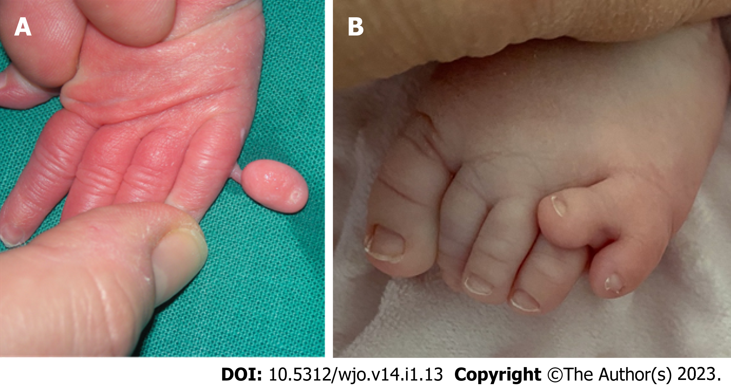 Postaxial polydactyly Type B in newborn hand and foot