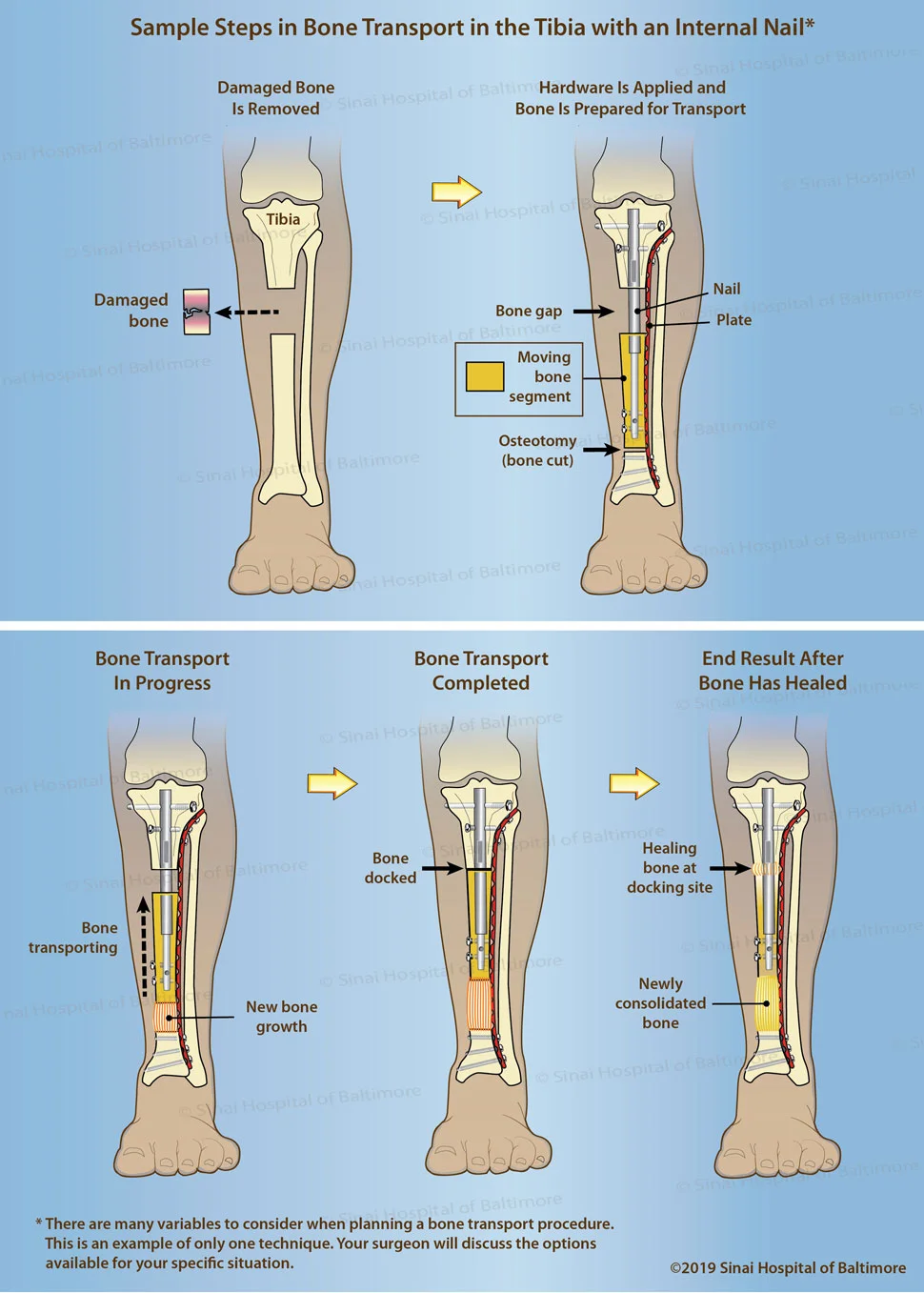 Bone Transport in Tibia with Internal Nail