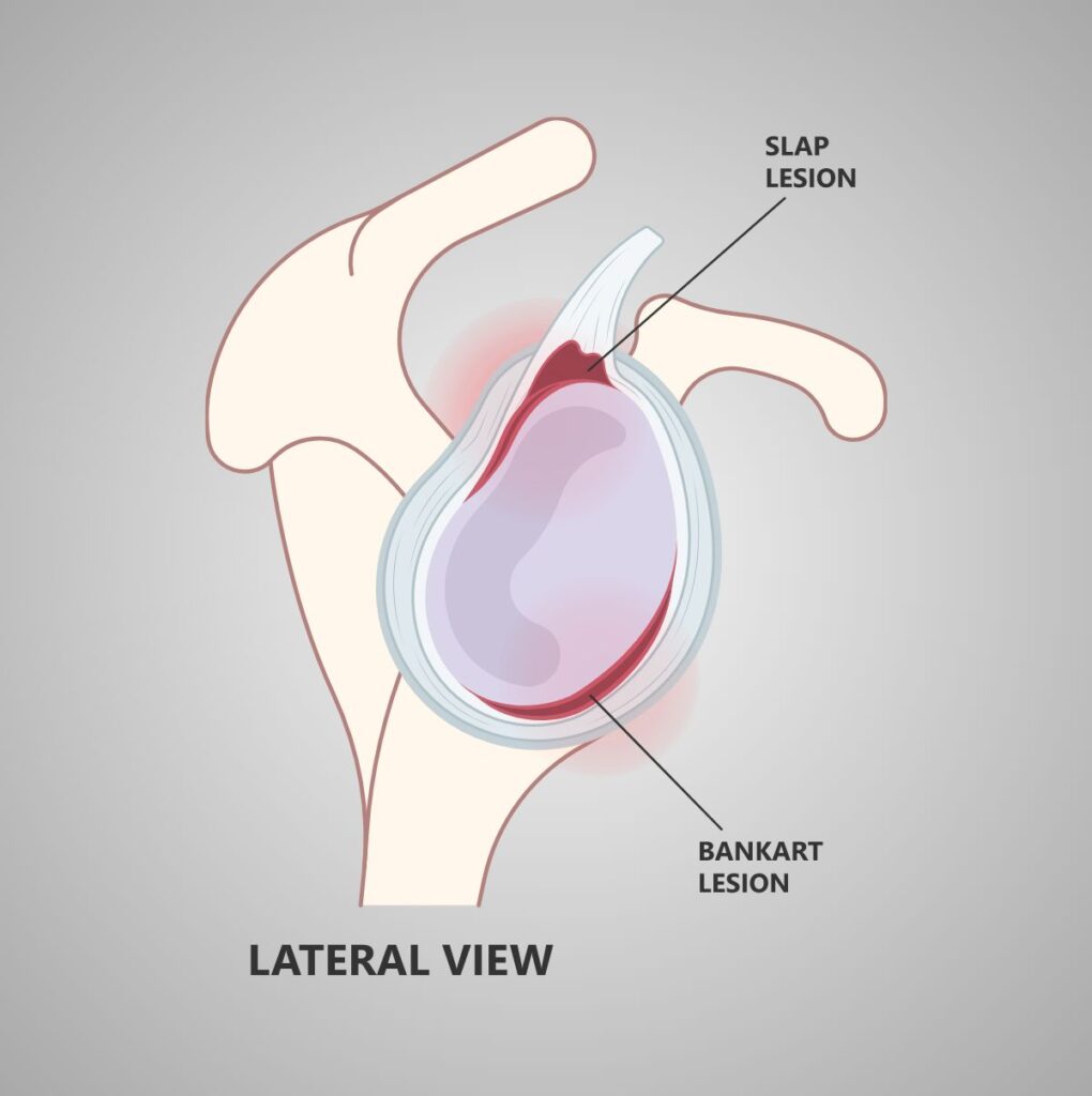 Bankart Lesion: Anterior Inferior Labral Tear