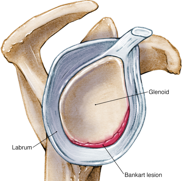 Bankart Lesion of the Shoulder