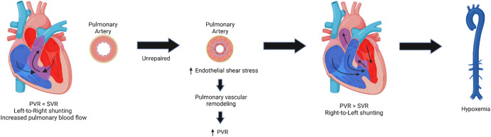 Eisenmenger syndrome pathophysiology